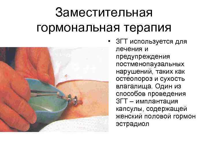 Заместительная гормональная терапия • ЗГТ используется для лечения и Заместительная гормональная терапия • ЗГТ используется для лечения и