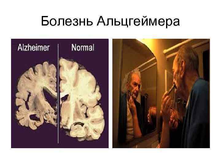 Болезнь Альцгеймера Болезнь Альцгеймера