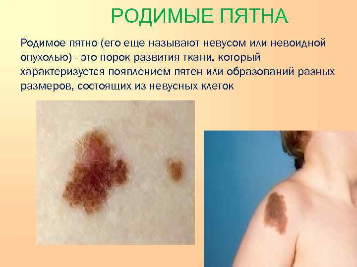    РОДИМЫЕ ПЯТНА  Родимое пятно (его еще называют невусом или невоидной