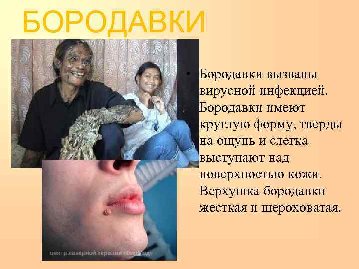 БОРОДАВКИ  • Бородавки вызваны  вирусной инфекцией.   Бородавки имеют  круглую