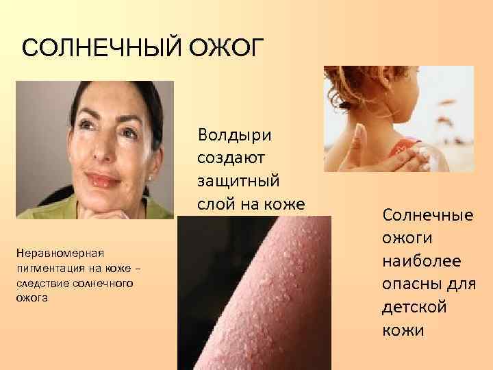 СОЛНЕЧНЫЙ ОЖОГ      Волдыри     создают 
