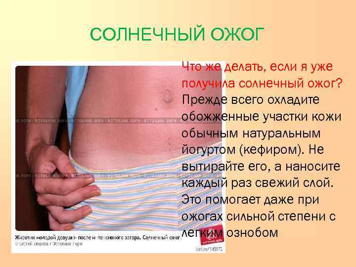     СОЛНЕЧНЫЙ ОЖОГ    Что же делать, если я