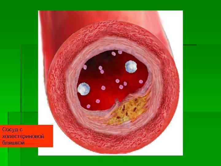 Сосуд с холестериновой бляшкой 