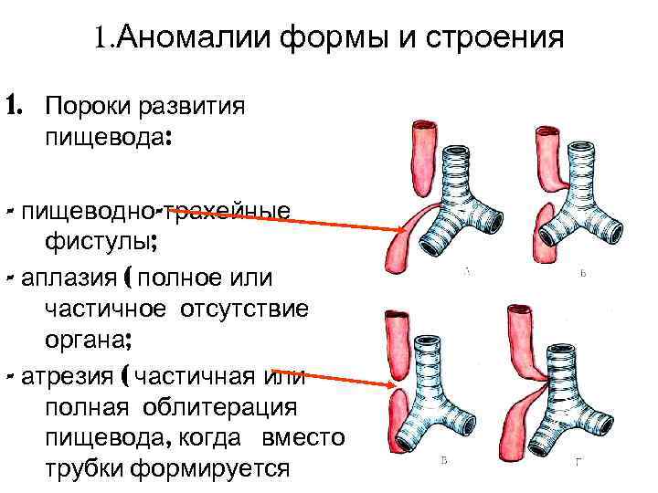  1. Аномалии формы и строения 1. Пороки развития  пищевода:  - пищеводно-трахейные