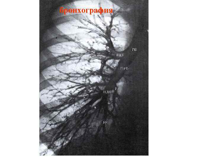 бронхография 