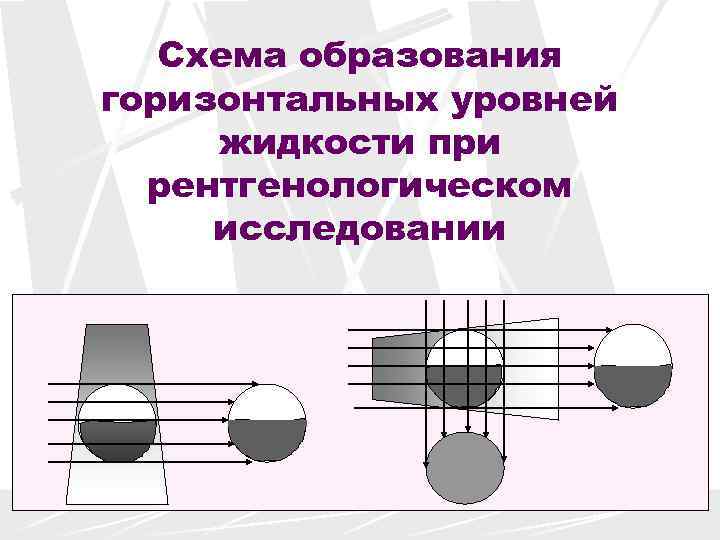   Схема образования горизонтальных уровней жидкости при  рентгенологическом исследовании 