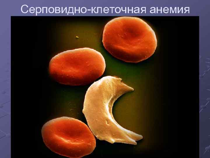 Серповидно-клеточная анемия 