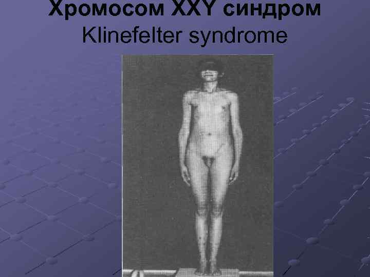 Хромосом XXY синдром  Klinefelter syndrome 