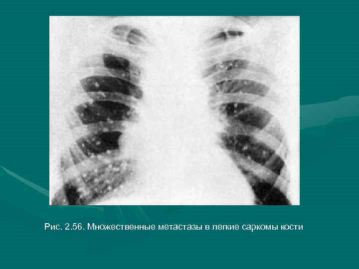 Метастазы в легких рентгенологическая картина