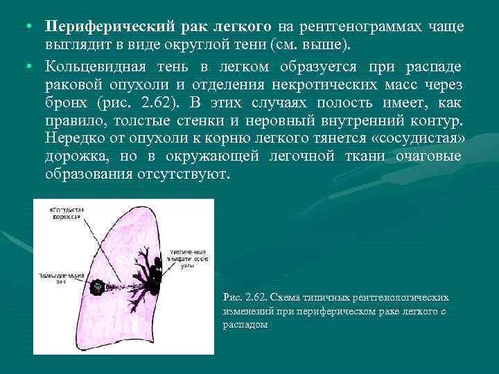 Лучевая картина центрального периферического и метастатического рака легкого