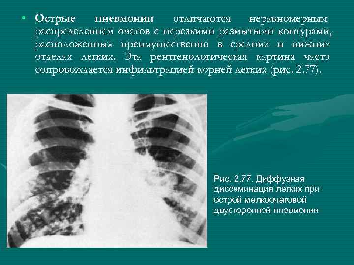  • Острые пневмонии отличаются  неравномерным  распределением очагов с нерезкими размытыми контурами,