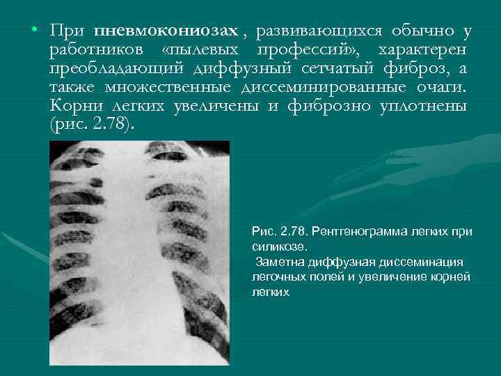  • При пневмокониозах , развивающихся обычно у  работников «пылевых профессий» , характерен