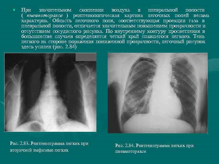 Как часто можно делать рентген легких. Полость в легком на рентгенограмме.