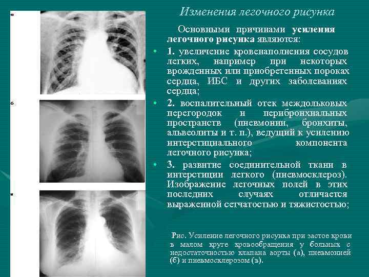 Легочный рисунок усилен в прикорневых отделах за счет сосудистого компонента