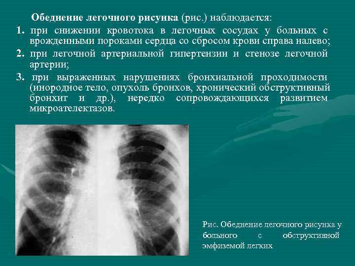 Усиление деформация легочного рисунка в прикорневых и базальных отделах