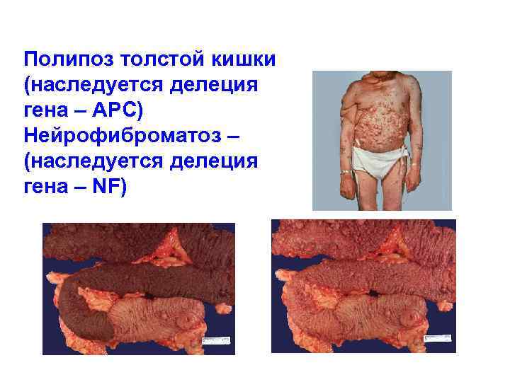 Полипоз толстой кишки (наследуется делеция гена – APC) Нейрофиброматоз – (наследуется делеция гена –