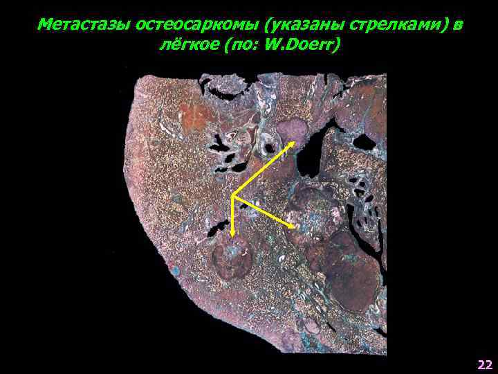 Метастазы остеосаркомы (указаны стрелками) в   лёгкое (по: W. Doerr)   