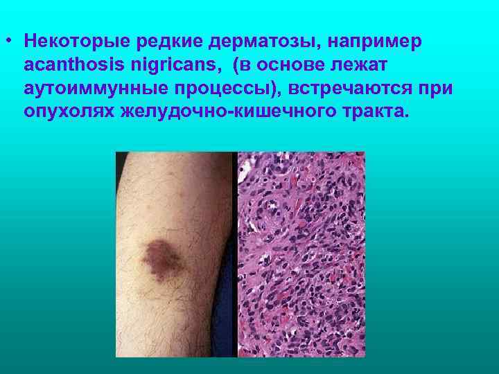  • Некоторые редкие дерматозы, например  acanthosis nigricans, (в основе лежат  аутоиммунные