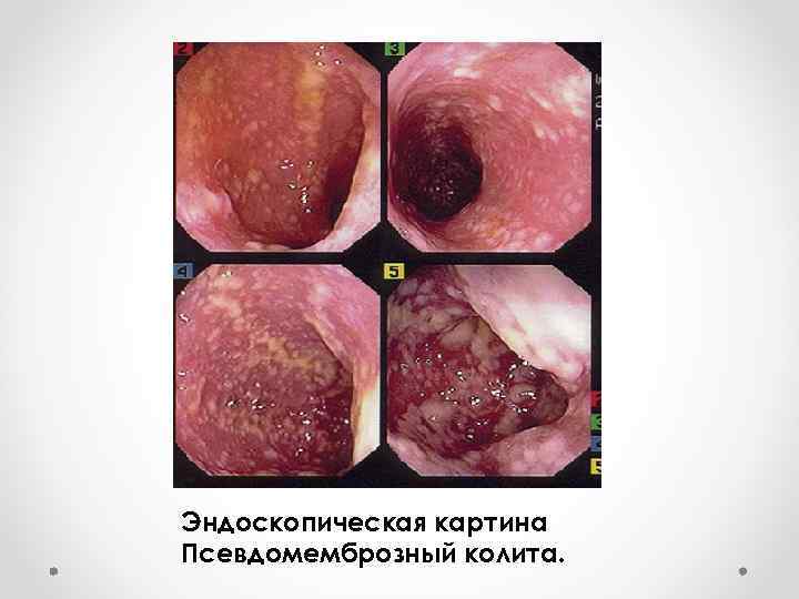   Диагностика Эндоскопическая картина Псевдомемброзный колита. 