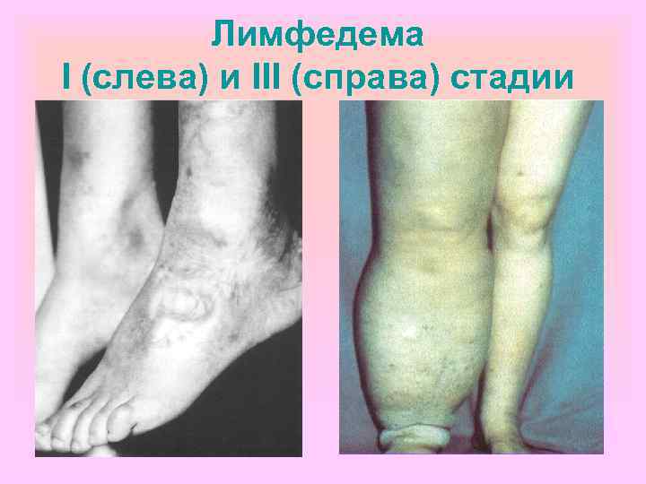    Лимфедема I (слева) и III (справа) стадии 