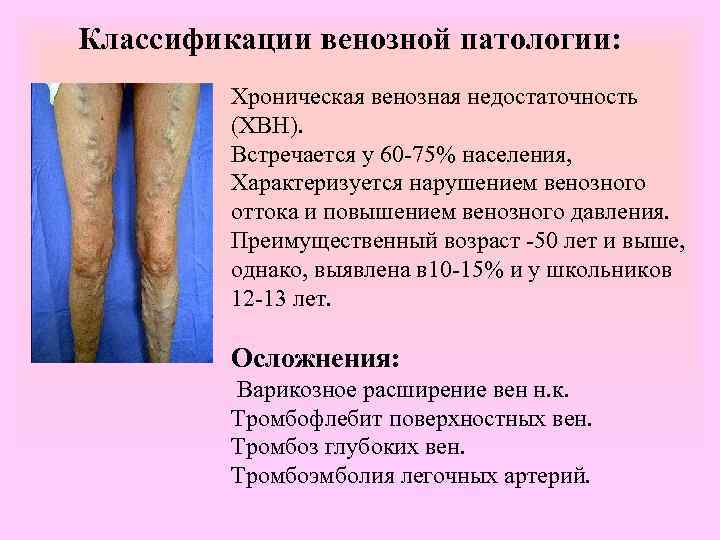Классификации венозной патологии:  Хроническая венозная недостаточность   (ХВН).  Встречается у 60