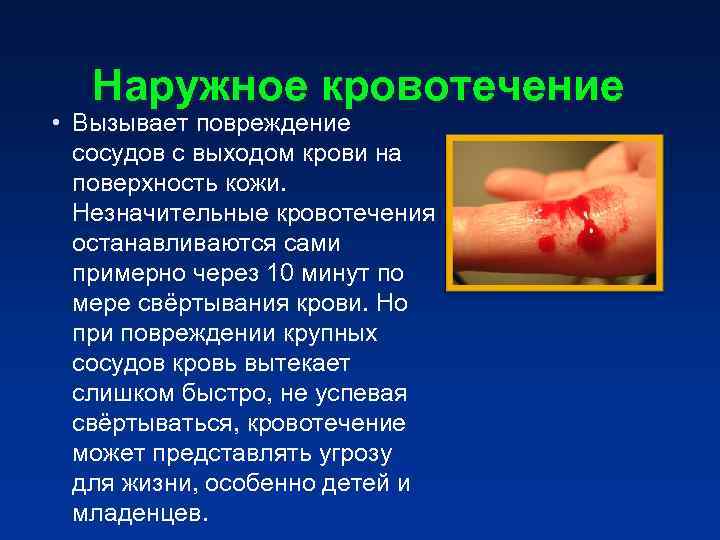 Наружное кровотечение • Вызывает повреждение сосудов с выходом крови на Наружное кровотечение • Вызывает повреждение сосудов с выходом крови на