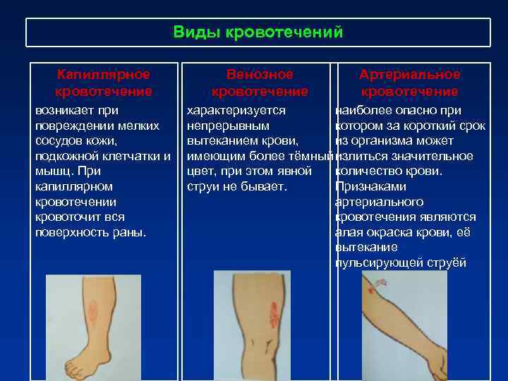 Виды кровотечений Капиллярное Венозное Виды кровотечений Капиллярное Венозное