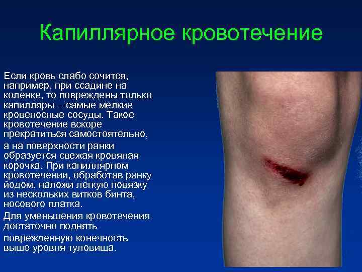 Капиллярное кровотечение Если кровь слабо сочится, например, при ссадине на коленке, Капиллярное кровотечение Если кровь слабо сочится, например, при ссадине на коленке,