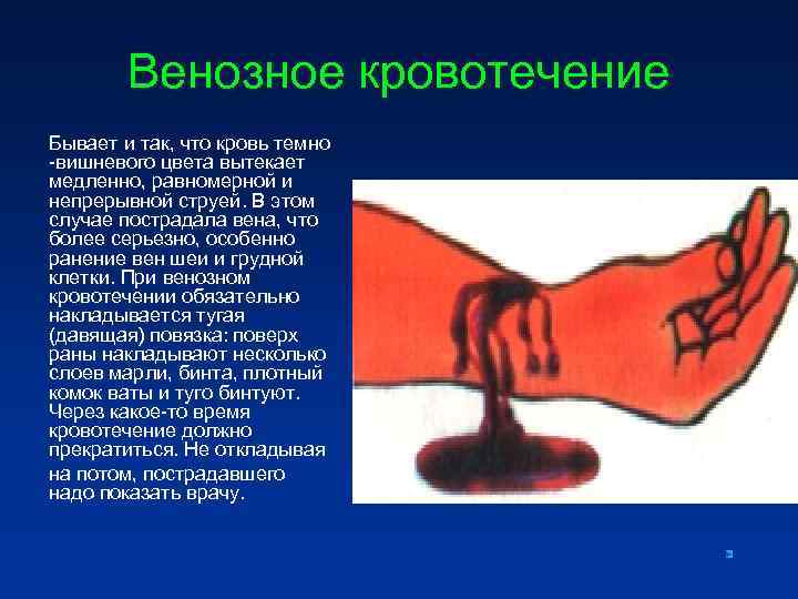 Венозное кровотечение Бывает и так, что кровь темно -вишневого цвета вытекает медленно, Венозное кровотечение Бывает и так, что кровь темно -вишневого цвета вытекает медленно,