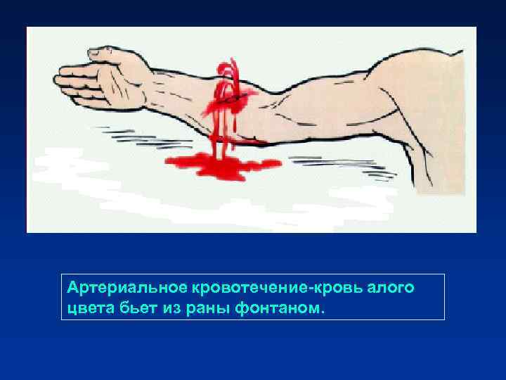 Артериальное кровотечение-кровь алого цвета бьет из раны фонтаном. Артериальное кровотечение-кровь алого цвета бьет из раны фонтаном.