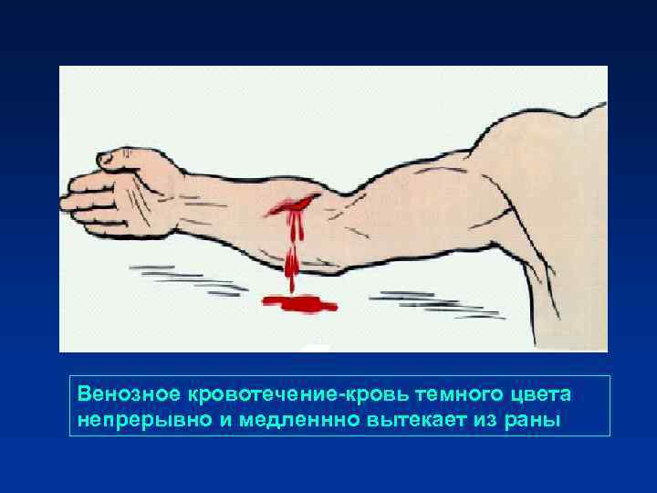 Венозное кровотечение-кровь темного цвета непрерывно и медленнно вытекает из раны Венозное кровотечение-кровь темного цвета непрерывно и медленнно вытекает из раны