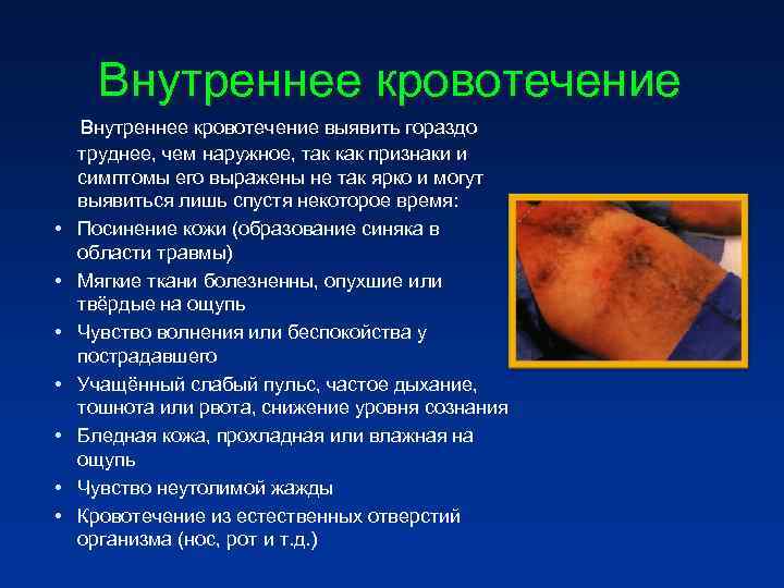 Внутреннее кровотечение выявить гораздо труднее, чем наружное, так как признаки и симптомы его Внутреннее кровотечение выявить гораздо труднее, чем наружное, так как признаки и симптомы его
