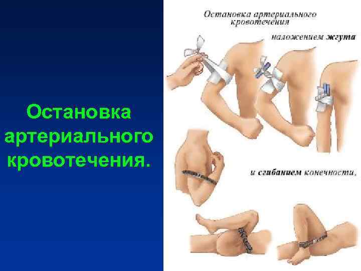 Остановка артериального кровотечения. Остановка артериального кровотечения.
