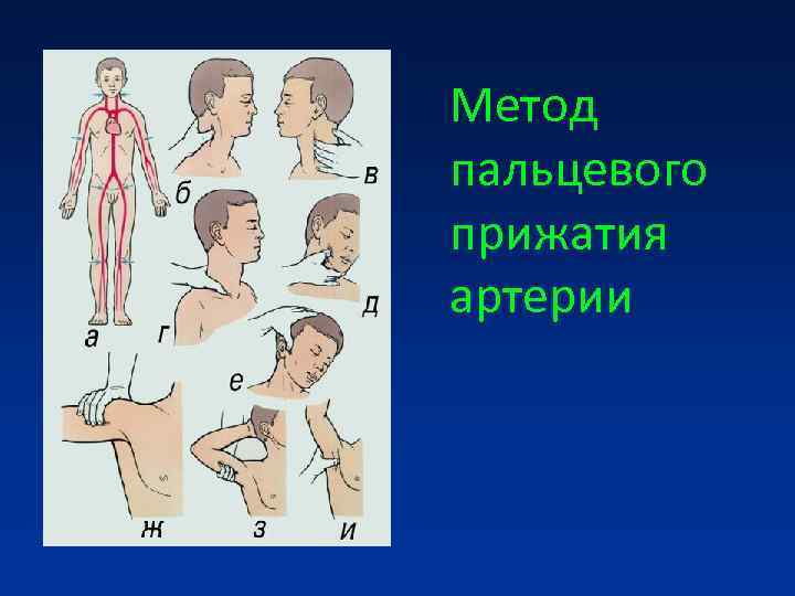 Прижатие сонной. Остановка кровотечения пальцевым прижатием алгоритм. Остановка кровотечения пальцевое прижатие артерий алгоритм. Метод пальцевого прижатия артерий. Методика пальцевого прижатия сосуда.