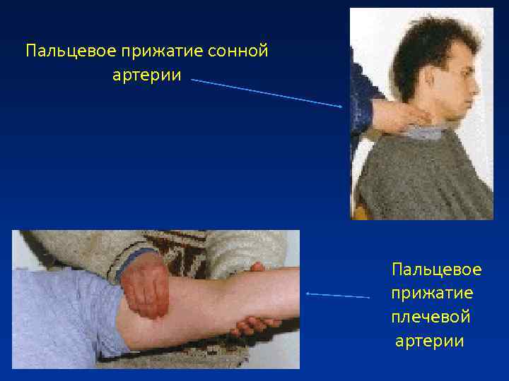 Пальцевое прижатие сонной артерии Пальцевое Пальцевое прижатие сонной артерии Пальцевое