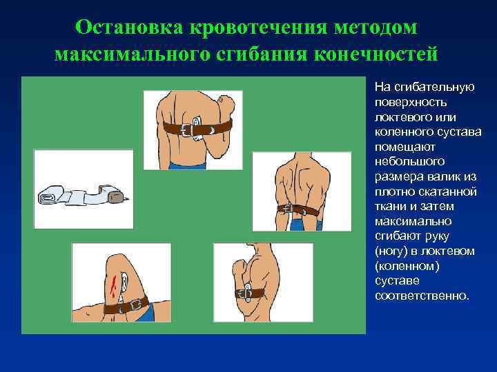 Остановка кровотечения презентация