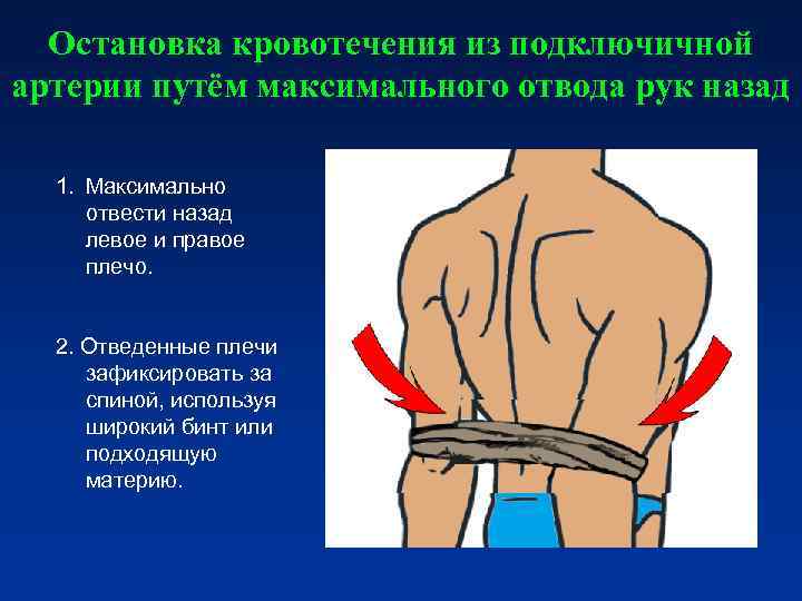 Остановка кровотечения из подключичной артерии путём максимального отвода рук назад 1. Максимально Остановка кровотечения из подключичной артерии путём максимального отвода рук назад 1. Максимально