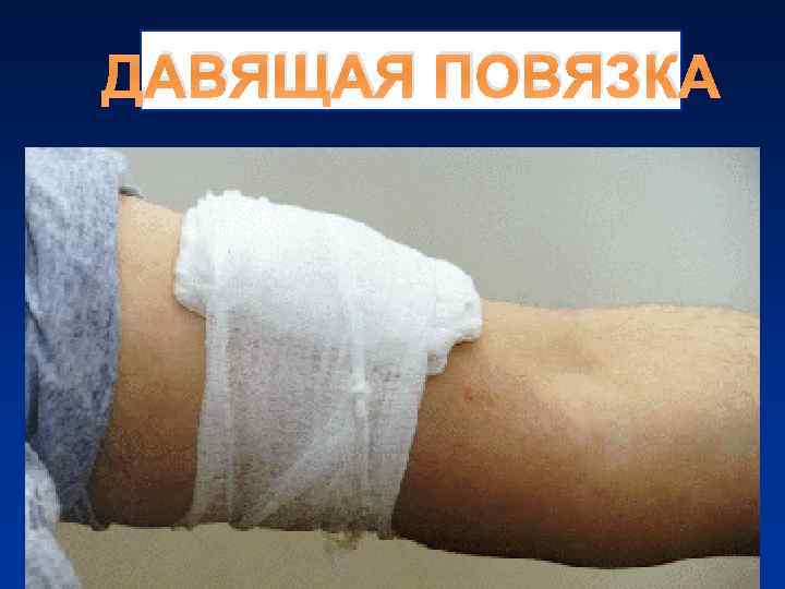 ДАВЯЩАЯ ПОВЯЗКА ДАВЯЩАЯ ПОВЯЗКА