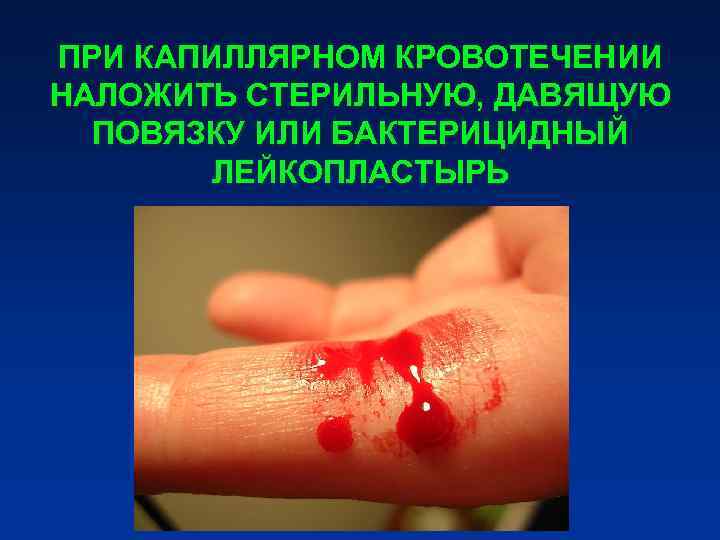 ПРИ КАПИЛЛЯРНОМ КРОВОТЕЧЕНИИ НАЛОЖИТЬ СТЕРИЛЬНУЮ, ДАВЯЩУЮ ПОВЯЗКУ ИЛИ БАКТЕРИЦИДНЫЙ ЛЕЙКОПЛАСТЫРЬ ПРИ КАПИЛЛЯРНОМ КРОВОТЕЧЕНИИ НАЛОЖИТЬ СТЕРИЛЬНУЮ, ДАВЯЩУЮ ПОВЯЗКУ ИЛИ БАКТЕРИЦИДНЫЙ ЛЕЙКОПЛАСТЫРЬ