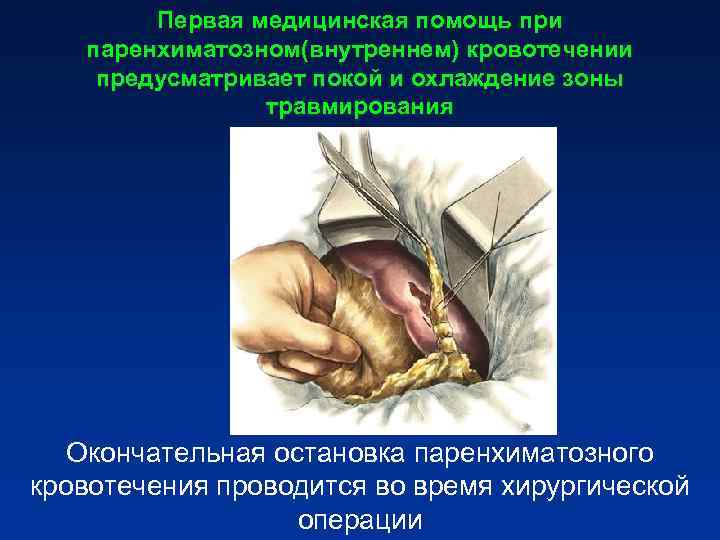 Первая медицинская помощь при паренхиматозном(внутреннем) кровотечении предусматривает покой и охлаждение зоны Первая медицинская помощь при паренхиматозном(внутреннем) кровотечении предусматривает покой и охлаждение зоны