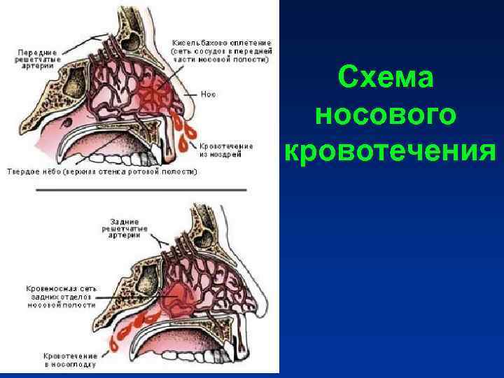 Схема носового кровотечения Схема носового кровотечения