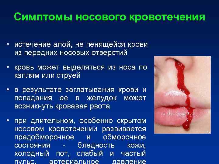 Симптомы носового кровотечения • истечение алой, не пенящейся крови из передних Симптомы носового кровотечения • истечение алой, не пенящейся крови из передних