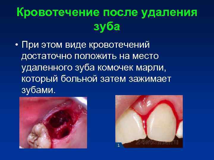 Кровотечение после удаления зуба • При этом виде кровотечений достаточно положить Кровотечение после удаления зуба • При этом виде кровотечений достаточно положить