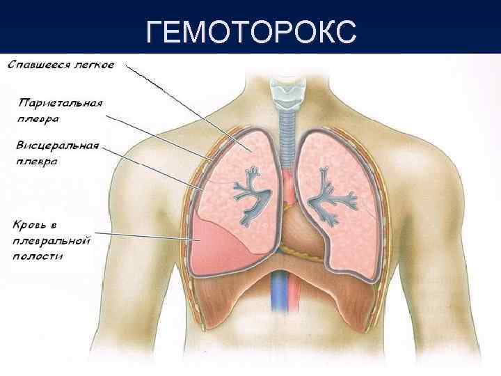 ГЕМОТОРОКС ГЕМОТОРОКС