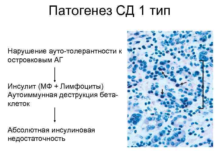   Патогенез СД 1 тип Нарушение ауто-толерантности к  островковым АГ  Инсулит