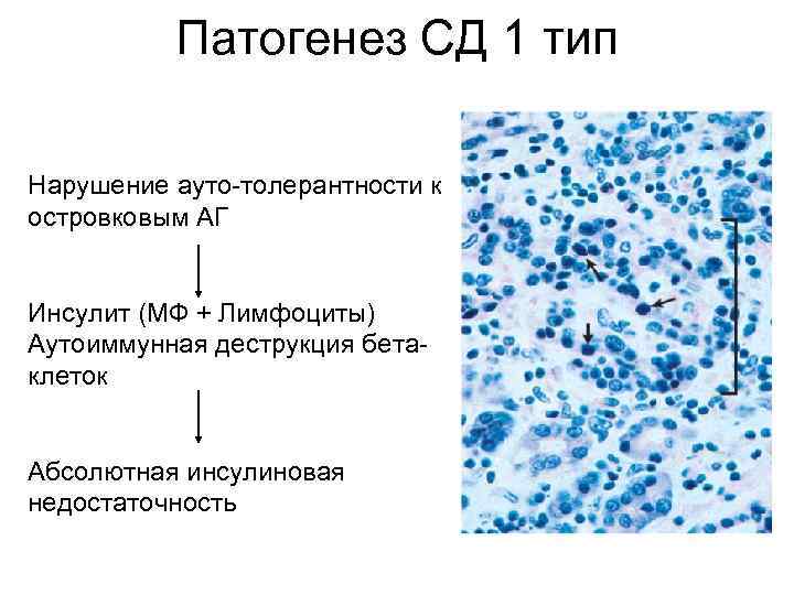 Патогенез СД 1 тип Нарушение ауто-толерантности к островковым АГ Инсулит (МФ + Лимфоциты) Аутоиммунная