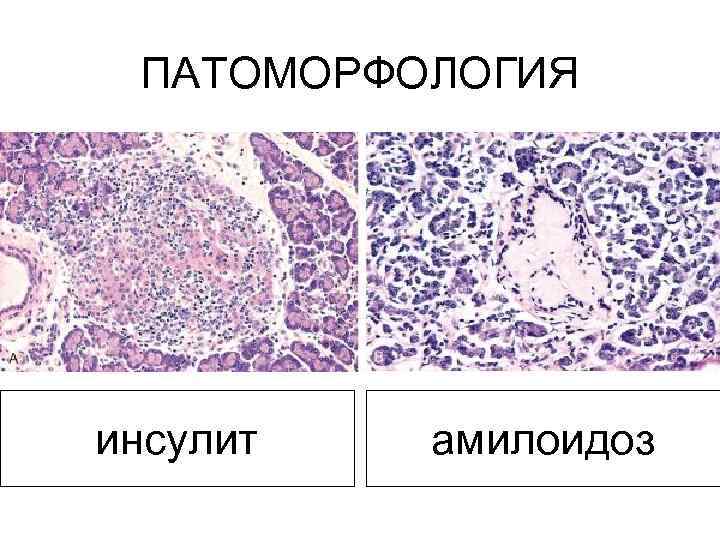 ПАТОМОРФОЛОГИЯ инсулит амилоидоз 