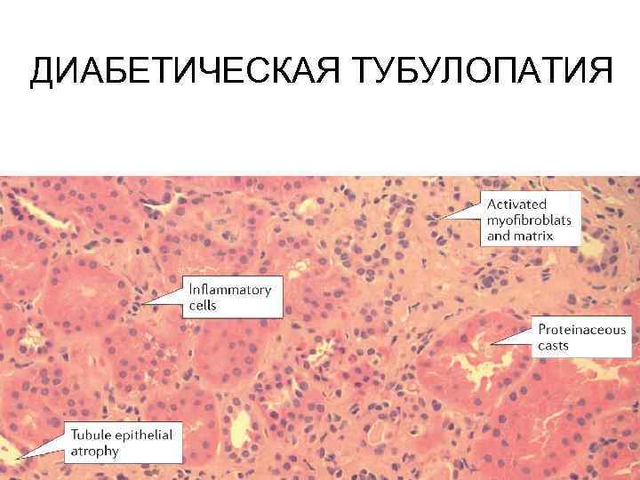 ДИАБЕТИЧЕСКАЯ ТУБУЛОПАТИЯ 