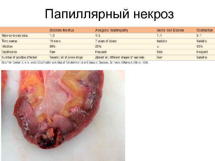 Папиллярный некроз 