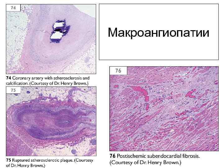 Макроангиопатии 